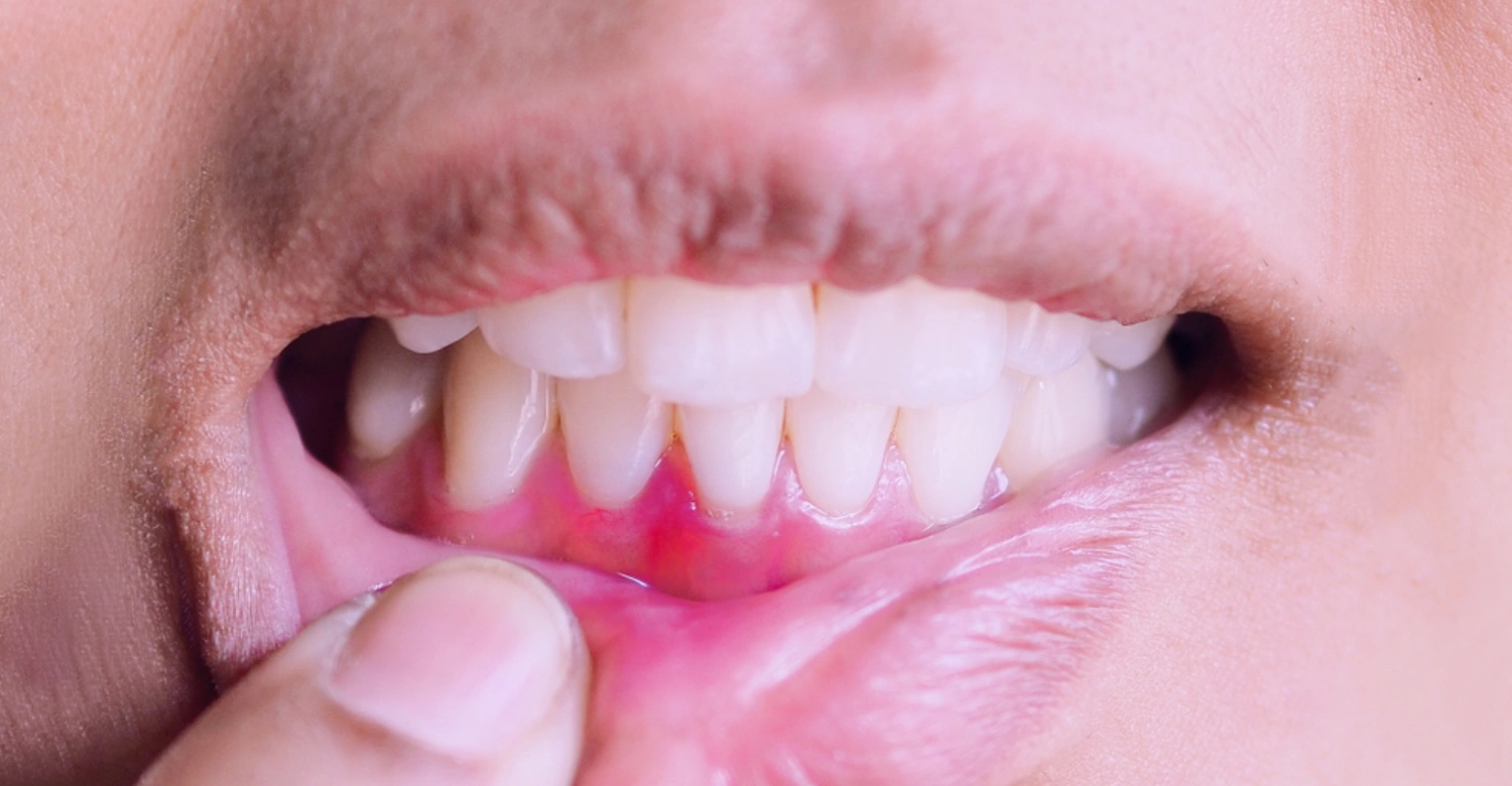 Swollen Gums Look Like Inblog